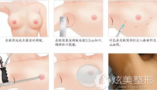 李英大院长做假体隆胸手术过程 李英大院长做假体隆胸手术过程