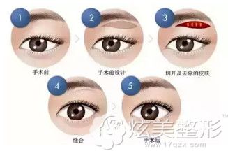 切眉术前后对比 切眉术前后对比