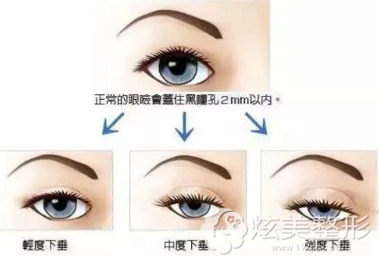眼部基础不错可以通过双眼皮来改善眼角下垂 眼部基础不错可以通过双眼皮来改善眼角下垂