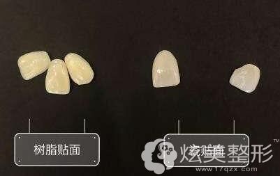 牙齿贴面:分为树脂贴面和瓷贴面 牙齿贴面:分为树脂贴面和瓷贴面