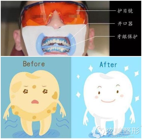 冷光美白:其实是牙齿漂白术 冷光美白:其实是牙齿漂白术