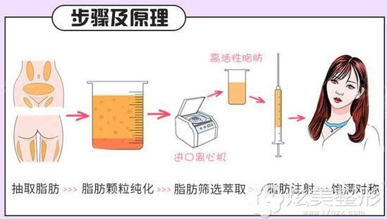 自体脂肪移植过程 自体脂肪移植过程