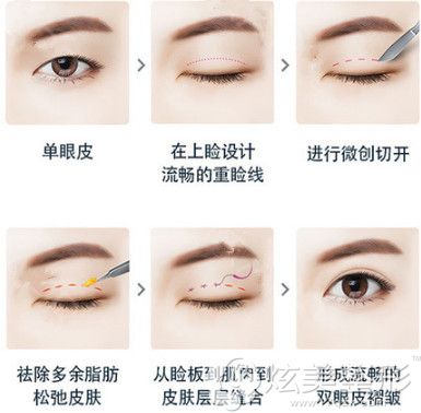 文珠峰院长做双眼皮手术 文珠峰院长做双眼皮手术
