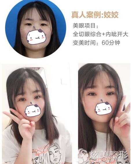 肿眼泡割双眼皮后真丑不这两组眼综合对比照就很自然
