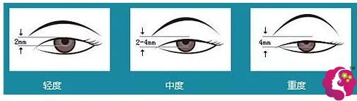 需要做上睑下垂矫正的眼睛 需要做上睑下垂矫正的眼睛
