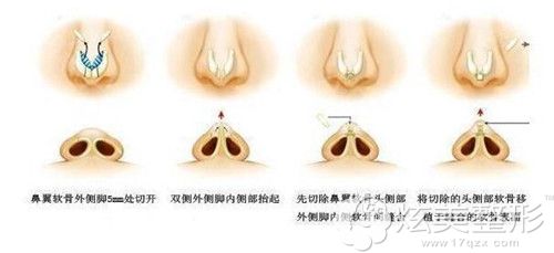 金振玉院长做鼻综合手术过程 金振玉院长做鼻综合手术过程