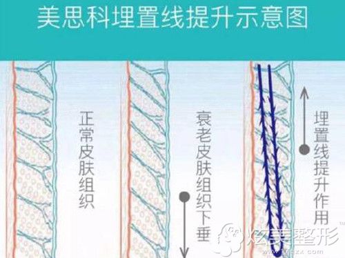 采用美思科埋线提升手术原理 采用美思科埋线提升手术原理