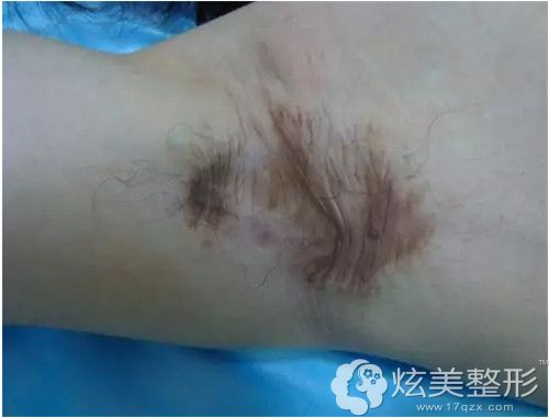 微创除腋臭术后有疤痕 微创除腋臭术后有疤痕