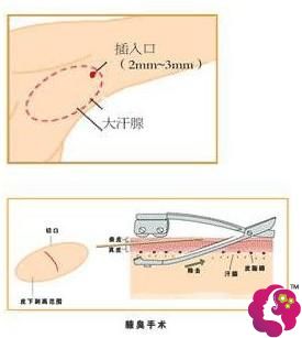 微创除腋臭手术过程 微创除腋臭手术过程