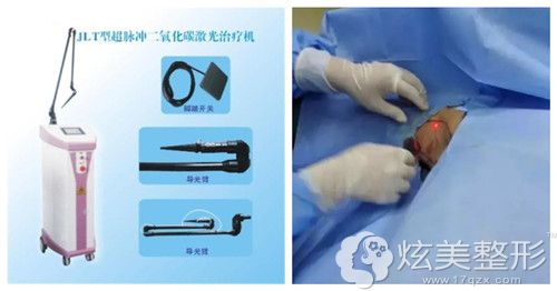 激光去腋臭过程 激光去腋臭过程