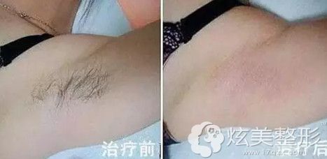 激光去腋臭效果对比 激光去腋臭效果对比