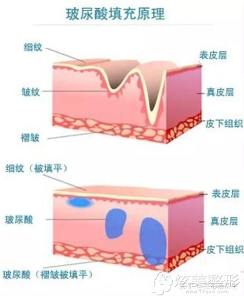 韩国LeeYoung整形院长孙京珍注射玻尿酸 韩国LeeYoung整形院长孙京珍注射玻尿酸