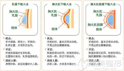 植入假体的位置不同也会影响痛感 植入假体的位置不同也会影响痛感