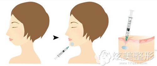 玻尿酸垫下巴的手术原理 玻尿酸垫下巴的手术原理