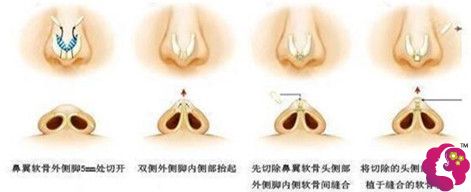 IN整形院长郑英河做综合鼻部整形手术 IN整形院长郑英河做综合鼻部整形手术