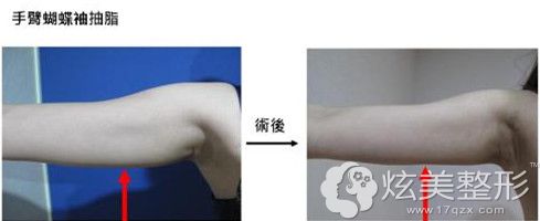 做完胳膊吸脂术后33天变细 做完胳膊吸脂术后33天变细