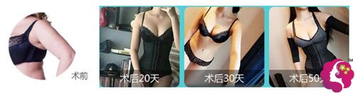 胳膊吸脂术后手臂变细没有反弹 胳膊吸脂术后手臂变细没有反弹