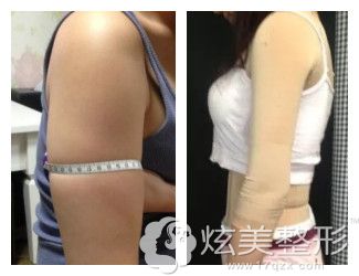 蝴蝶袖抽脂后1个月没效果主要是因为没恢复 蝴蝶袖抽脂后1个月没效果主要是因为没恢复