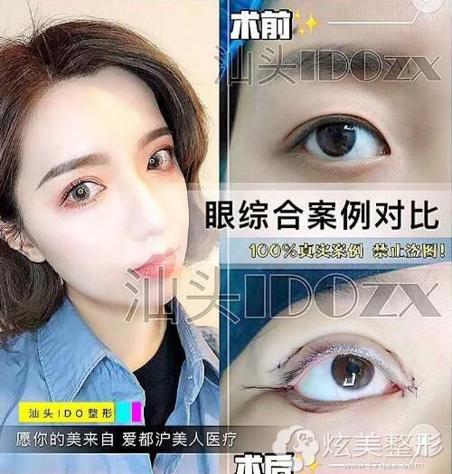 想要网红风的双眼皮隆鼻汕头的姑娘可以看这家对比照