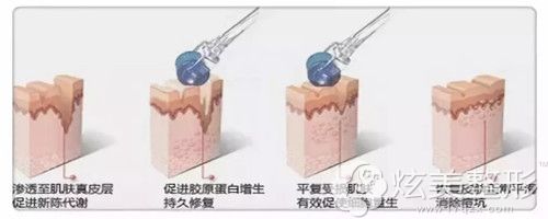 黄金微针祛痘原理 黄金微针祛痘原理