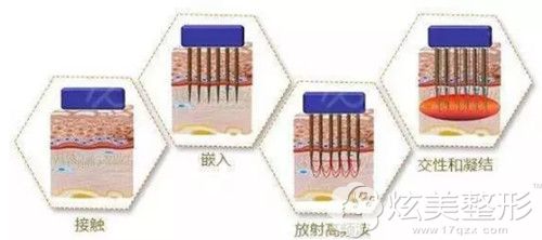 皮肤炎症长痘能直接做黄金微针 皮肤炎症长痘能直接做黄金微针