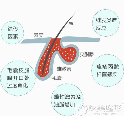 黄金微针后爆痘的原因 黄金微针后爆痘的原因