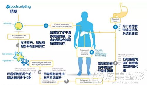 酷塑冷冻溶脂通过新陈代谢来瘦身 酷塑冷冻溶脂通过新陈代谢来瘦身