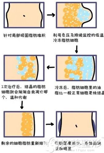 酷塑冷冻溶脂过程 酷塑冷冻溶脂过程