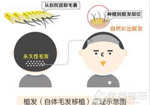王医生做毛发移植手术步骤示意图 王医生做毛发移植手术步骤示意图