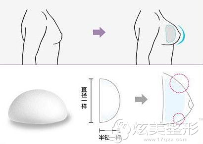 金在洪院长做假体隆胸手术 金在洪院长做假体隆胸手术