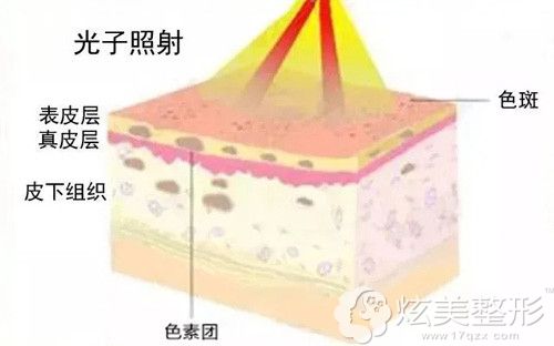 采用光子嫩肤opt祛斑手术原理 采用光子嫩肤opt祛斑手术原理