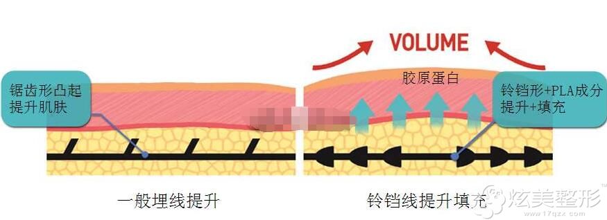 铃铛线埋线提升和一般埋线的区别 铃铛线埋线提升和一般埋线的区别