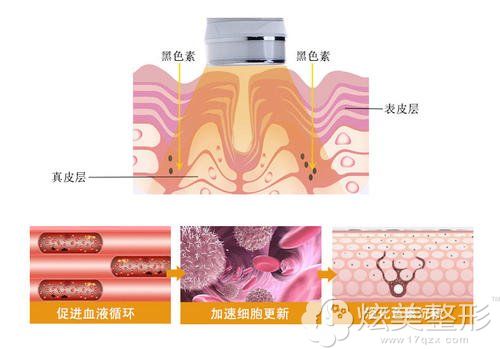 采用LED红蓝光祛痘的手术原理 采用LED红蓝光祛痘的手术原理