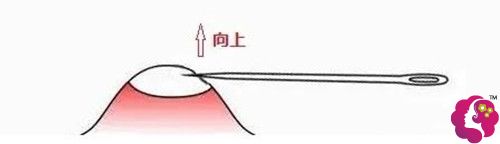 针清祛痘的手术原理 针清祛痘的手术原理