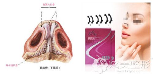 鼻梁轻微歪斜用鼻梁矫正器 鼻梁轻微歪斜用鼻梁矫正器