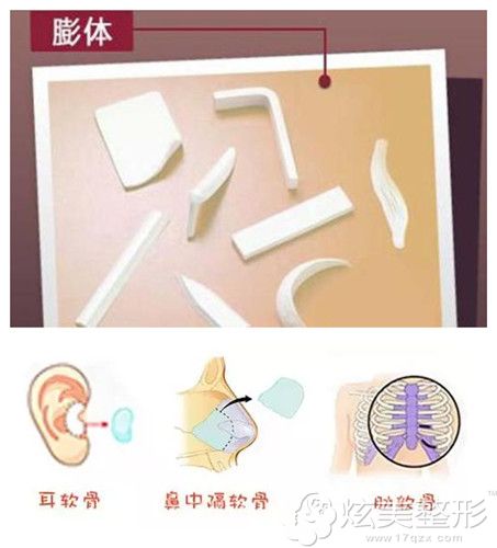 自体软骨和膨体隆鼻 自体软骨和膨体隆鼻