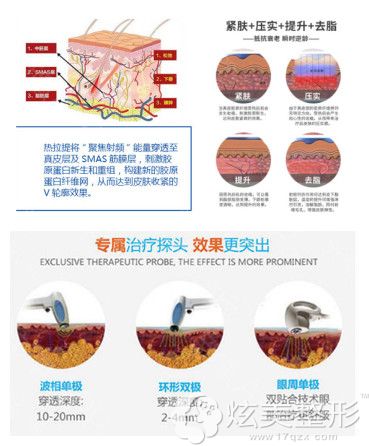 深蓝射频、热玛吉、热拉提原理上有所不同 深蓝射频、热玛吉、热拉提原理上有所不同