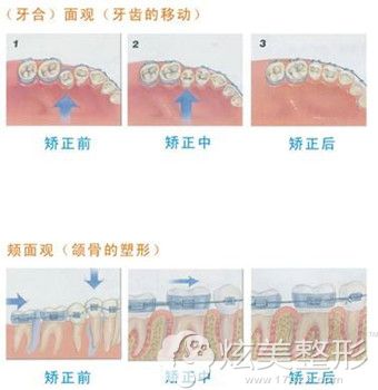 覃医生做牙齿矫正的手术原理图 覃医生做牙齿矫正的手术原理图