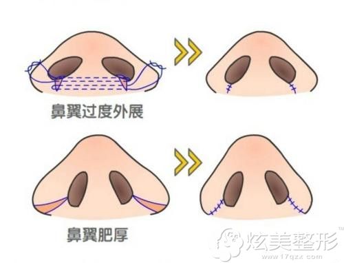 鼻头缩小手术效果明显 鼻头缩小手术效果明显