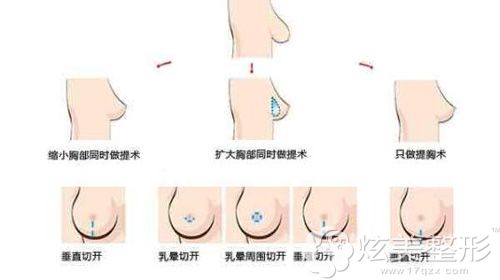 做乳房垂直上提术的手术步骤示意图 做乳房垂直上提术的手术步骤示意图