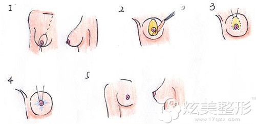 做乳房双环上提矫正术原理 做乳房双环上提矫正术原理