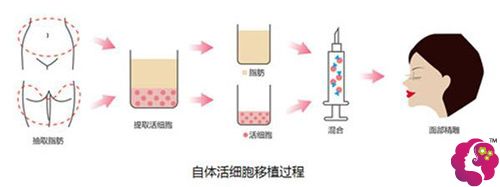 张医生做自体脂肪面部填充示意图 张医生做自体脂肪面部填充示意图