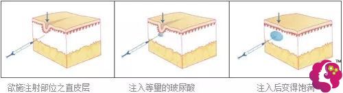曹院长做玻尿酸除皱的手术原理 曹院长做玻尿酸除皱的手术原理