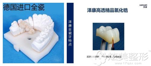 德国泽康全瓷牙 德国泽康全瓷牙