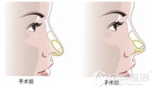 做肋软骨隆鼻修复手术示意图 做肋软骨隆鼻修复手术示意图