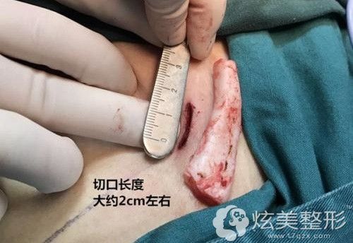 手术中取肋软骨雕刻的伤口 手术中取肋软骨雕刻的伤口