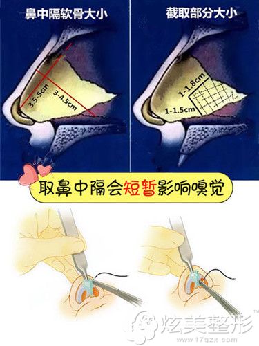 肋骨鼻可能会暂时影响鼻子嗅觉 肋骨鼻可能会暂时影响鼻子嗅觉