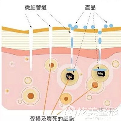 手动微针祛痘印原理 手动微针祛痘印原理