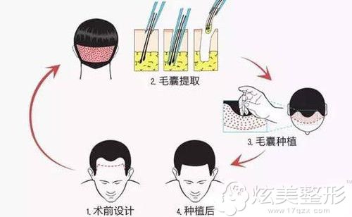 ��Ժ����ë����ֲ������ԭ��ͼ