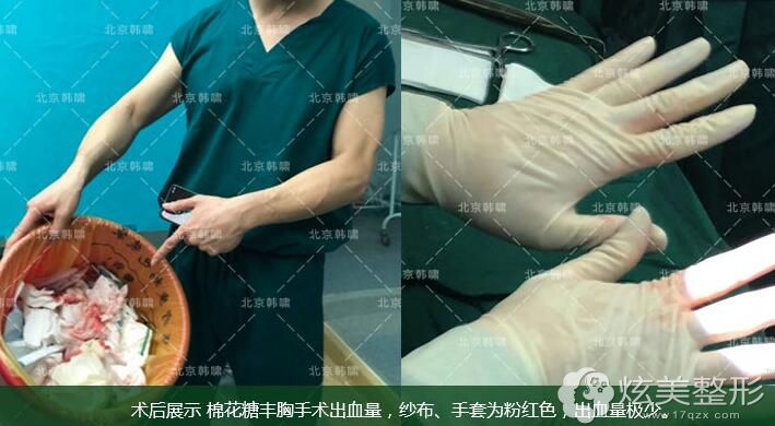 后展示棉花糖丰胸手术出血量,纱布、手套为粉红色,出血量极少 后展示棉花糖丰胸手术出血量,纱布、手套为粉红色,出血量极少